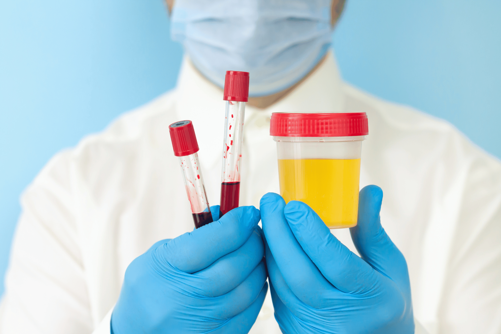 Ethyl Glucuronide Urine Test