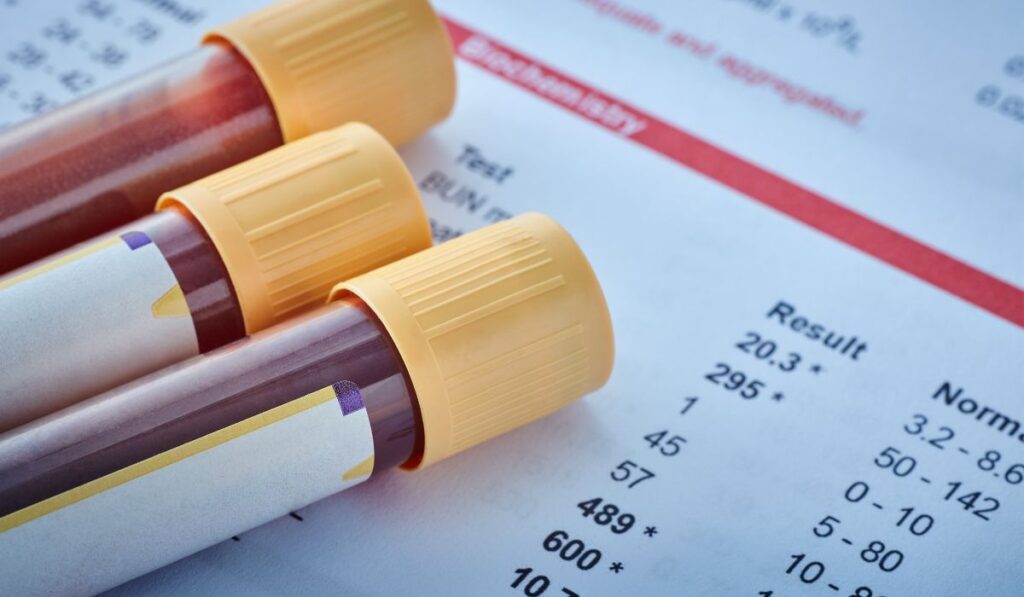Does Lorazepam Show Up on a Drug Test 1